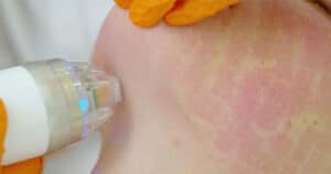 genius rf microneedling here are the faqs 63879906257f0