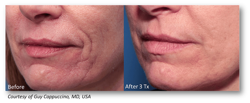 Microneedling